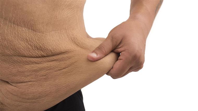 افتادگی پوست بعد از لاغری